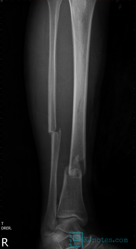 脛腓骨開放性骨折X光片-bonefracture001