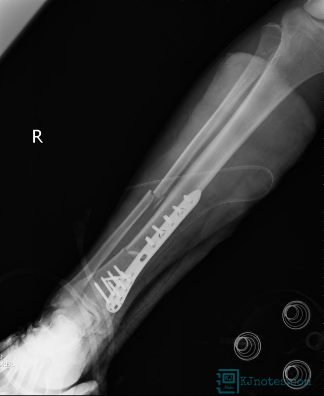 脛腓骨開放性骨折手術後X光片-bonefracture011