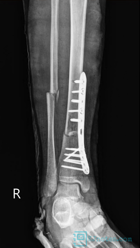 20220920脛腓骨開放性骨折回珍X光片-bonefracture021