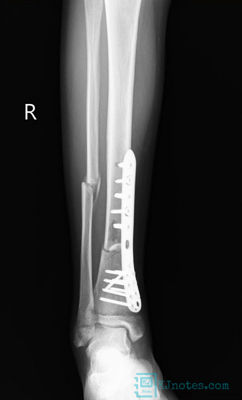 20221018脛腓骨開放性骨折回珍X光片-bonefracture031