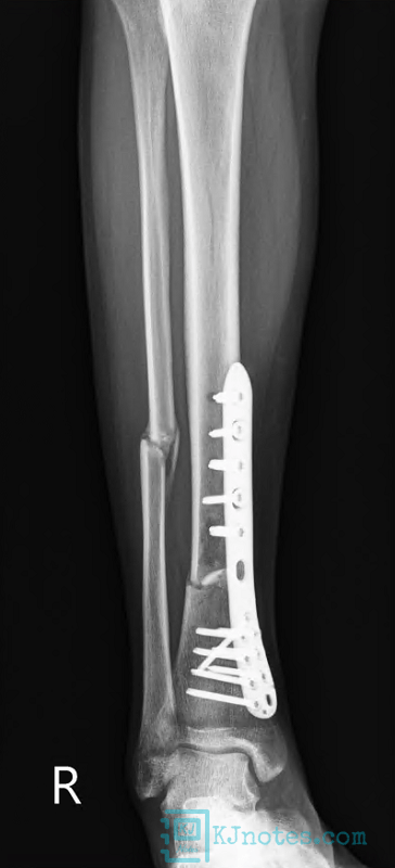 20221129脛腓骨開放性骨折回珍X光片-bonefracture041