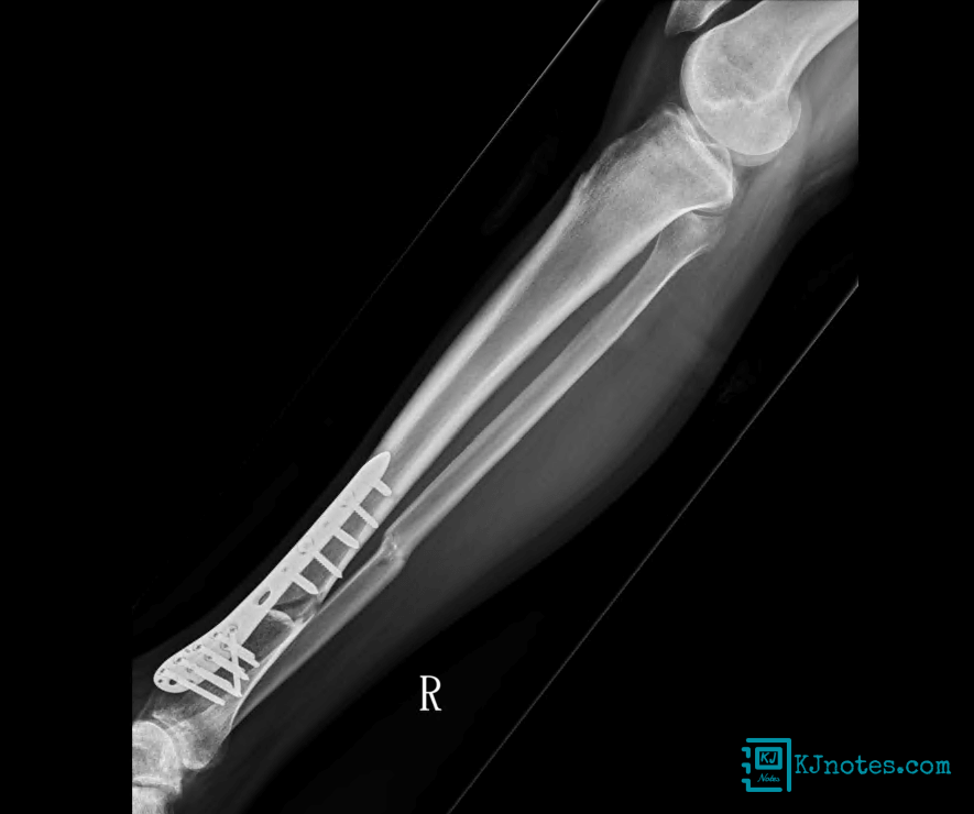 20230118脛腓骨開放性骨折回珍X光片-bonefracture052
