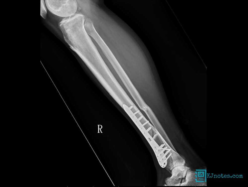 20230412脛腓骨開放性骨折回珍X光片-bonefracture096