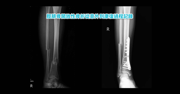 脛腓骨開放性骨折從意外到康復過程記錄